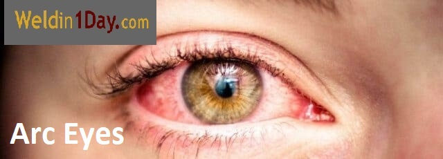 Arc eyes. Flash burning. Welding eye burn. Flash burn eye. Welders flash.